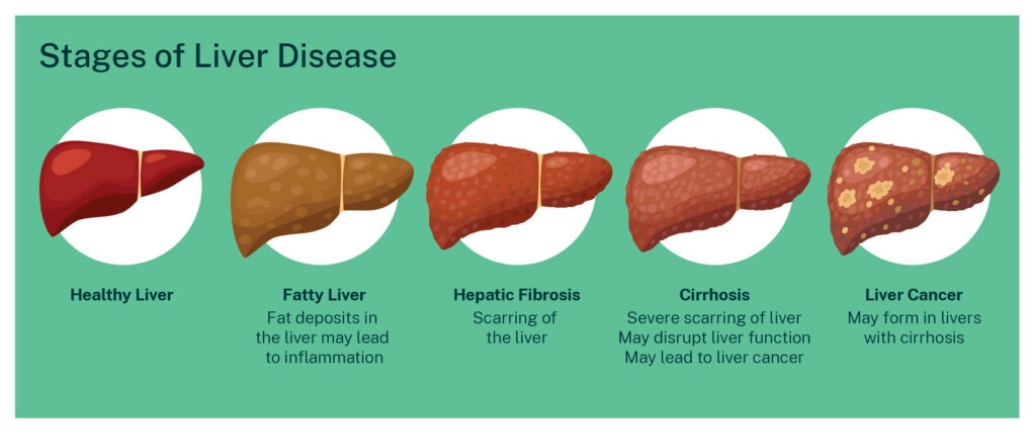 Liver Disease Management - Dr Farah Beshoy